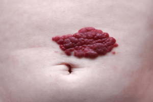 Featured Image for hemangioma birthmark on belly