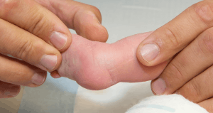 Featured Image for infant with clubfoot