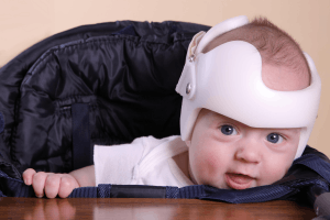 Featured Image for Child with plagiocephaly helmet