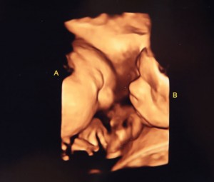 fetal ultrasound