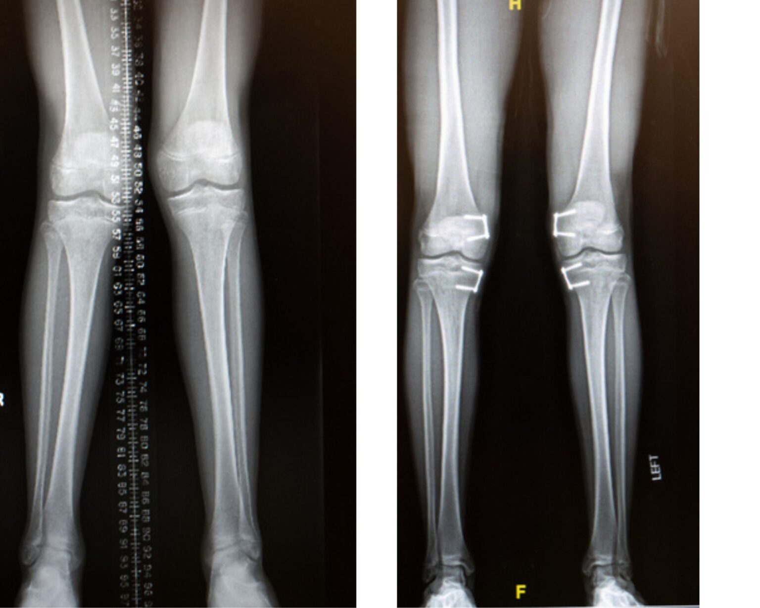 Guided Growth Surgery Helps Teen With Knock Knees : Inside Children's Blog