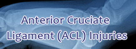 Kidshealth: Anterior Cruciate Ligament (ACL) Tears | Akron Children's ...