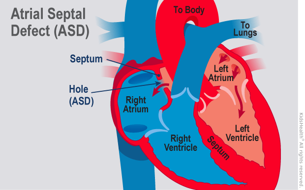 Kidshealth Atrial Septal Defect Asd Akron Children S Hospital