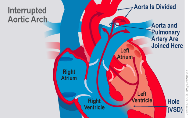 types of aortic arch
