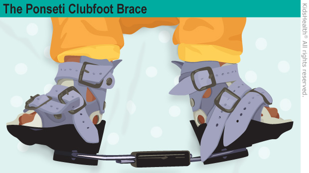 Kidshealth The Ponseti Method Bracing Phase Akron Children S Hospital