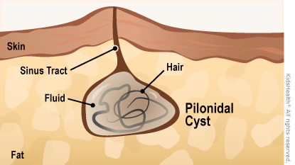 Pilonidal Sinus and Pilonidal Cyst